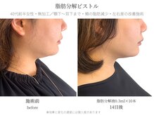 サボラミ(sabor A Mi)/気になる顎下も１回でスッキリ◎