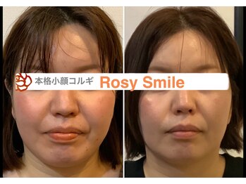 ロージースマイル(Rosy smile)の写真/速攻小顔×持続力◎【本格韓国式コルギ】