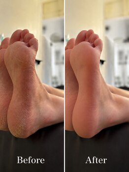 HAND&FOOTsalon tete.【5/30 NEW OPEN（予定）】の写真/ガサガサかかと・タコ・魚の目などのお悩み解消！素足に自信がもてる！