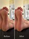 HAND&FOOTsalon tete.【5/30 NEW OPEN（予定）】の写真/ガサガサかかと・タコ・魚の目などのお悩み解消！素足に自信がもてる！