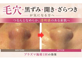 エステサロン カツキ(KATUKI)の写真/美肌WAX脱毛やプラズマ等で毛穴レスを実現♪化粧ノリ抜群の引き締まった発光ツヤ肌ケアで理想の自分へ◎
