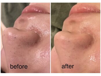 ココ(coco)/ハーブピーリング初回♪