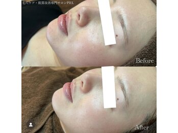 ピエル 北千住店(PIEL)/お肌の赤み乾燥でお悩みのお客様