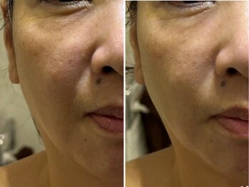 リジェ(Rege)の写真/《最高級のエイジングケア》肌の活性能力をエクソソームで最大限に引き出し速攻性＆持続性◎