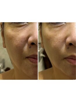 ホウレイ線・たるみ改善！予防ケア