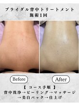 シーフェイス 横浜店(SEE FACE)/ブライダル背中美白ケア！直前OK