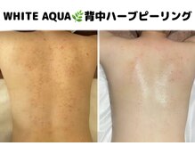 ホワイトアクア 柏店(WHITE AQUA)/ボディピーリング/ニキビケア