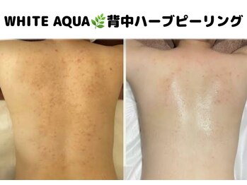 ホワイトアクア 柏店(WHITE AQUA)/ボディピーリング/ニキビケア