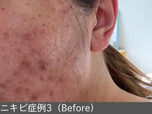 オアシスラグーン(OASIS LAGOON)/ニキビ改善（症例3 before）