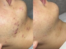 エモーショナル 姫路(Emotional)/ニキビケアにハーブピーリング☆