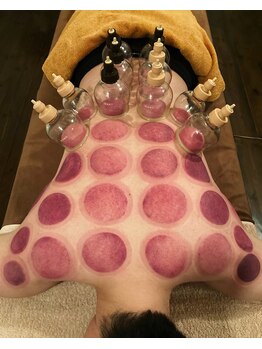 芦田整体療術院/吸玉療法