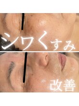 サロンドエテ(salon de ete)/シワくすみ改善