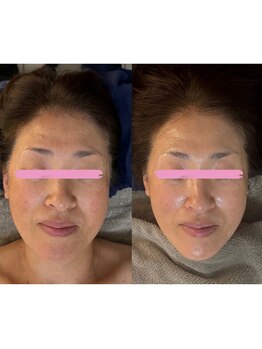 ザ レディービー(The Lady B)/小顔＆エイジングケア