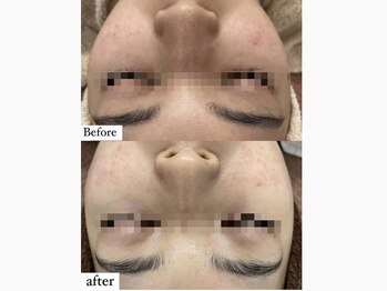 アワピール 成田公津の杜店(AWA PEELL)/ハーブピーリング/千葉/公津の杜