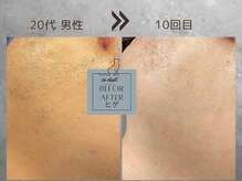 ル シャ/メンズ脱毛/毛穴洗浄/ヘッドスパ