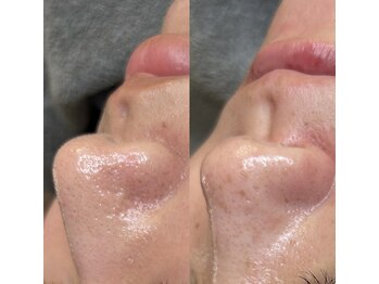 クリスタルビューティ 渋谷/【LHALALAララピール】