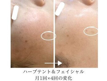 こもれび/温活×フェイシャルの変化