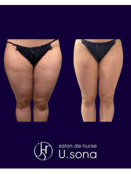 小顔・脂肪コントロール専門 salon de nurse U.sona～松本店～/【痩身】太もも脂肪分解症例