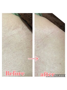 サロンシャイン(Salon Shine)/背中の毛