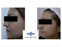 フェイシャルスタイリストサロン 四谷店/ケア例(47)