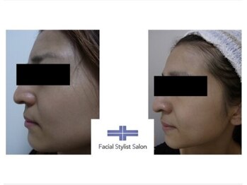 フェイシャルスタイリストサロン 四谷店/ケア例(47)