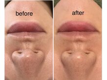 ココ(coco)/ハーブピーリング初回