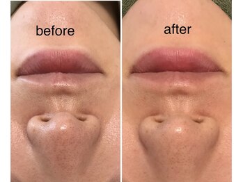 ココ(coco)/ハーブピーリング初回