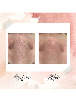 リライフ(ReLIFE)/ハイドラフェイシャルで毛穴洗浄