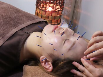 瀬戸の杜鍼灸治療院 アンド ピュアボディ(Pure body)/人気の美容鍼
