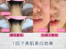 THR脱毛効果◎つるんとしたお肌に☆