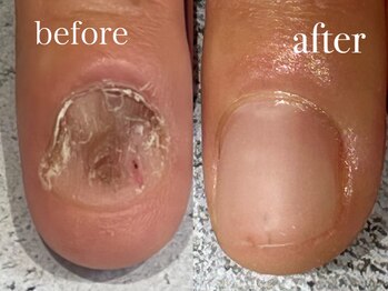 グラシナ なんば店/深爪/自爪育成/フィルイン