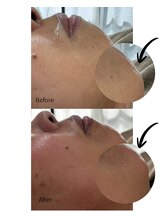 エヌクレアール(Ncrear)/顎ひげ、意外と見えてます。