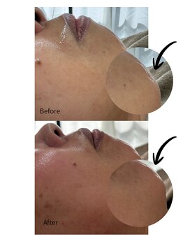 エヌクレアール(Ncrear)/顎ひげ、意外と見えてます。