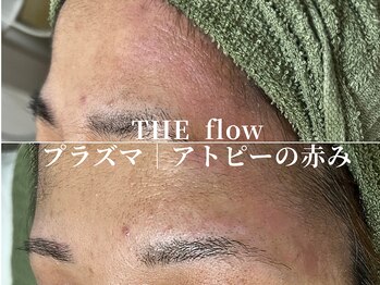 ザ フロウ(THE flow)/プラズマで肌トラブルや赤みケア
