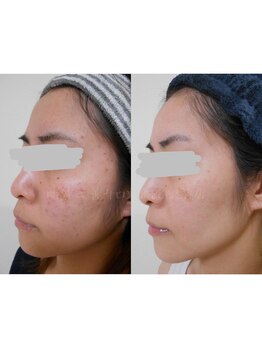 肌質改善サロン 姫路駅前店/肌質改善：ニキビケア