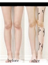 エクリル(Eclire)/むくみ改善