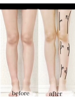 エクリル(Eclire)/むくみ改善