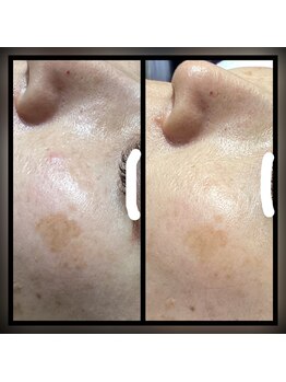 ココスタイルビューティー(COCOSTYLE beauty)/シミ改善し放題