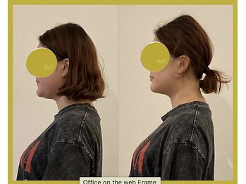 ルク ソル(Luxsol)/小顔矯正