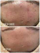 イリゼ(IRISER)/【20代肌改善】ニキビ、肌荒れ