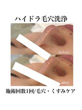 サラ/ハイドラ毛穴洗浄