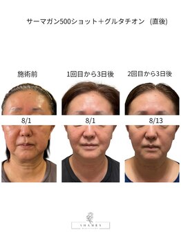 シャムリー(SHAMRY)/サーマガン500＋脂-肪-溶-解