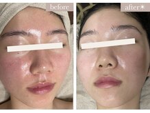 エバーグリーン(Evergreen)/ハーブピーリング×ヒト幹細胞