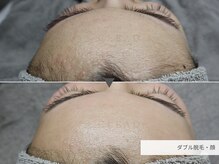 クリード(CLEAD)/フェイシャルダブル脱毛