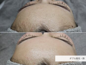 クリード(CLEAD)/フェイシャルダブル脱毛