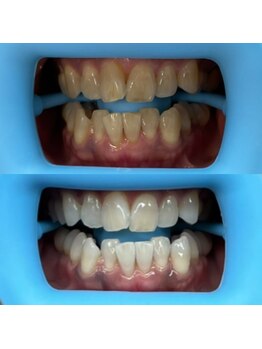 ホワイトニングセンター 富山二口店/富山 二口町ホワイトニング