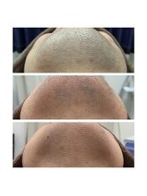 アンジェリーナ/ヒゲ脱毛/2回、5回照射