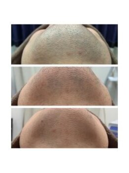 アンジェリーナ/ヒゲ脱毛/2回、5回照射