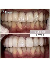 イージーホワイトニング 神戸三宮店(easy whitening)/お客様の症例写真です★