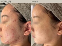 ベベ 表参道(bebe)の雰囲気（肌質管理/毛穴/ニキビはbebe表参道で♪）